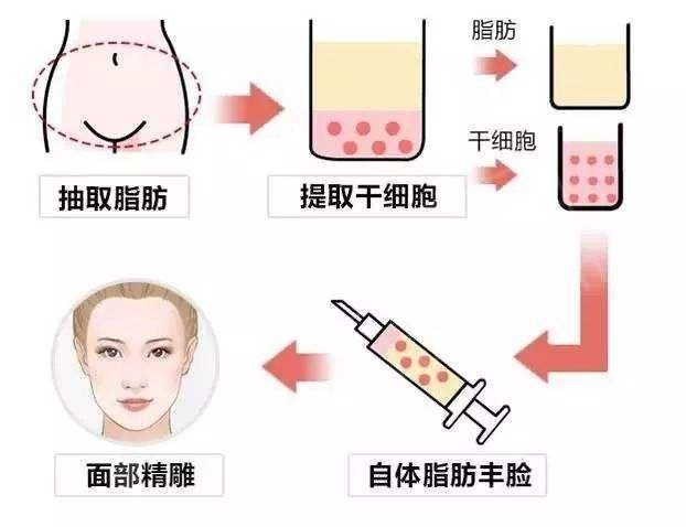 最新溶脂技术，重塑身材的革命之道