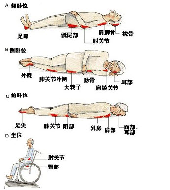 最新压疮分期研究，深度解析与处理策略