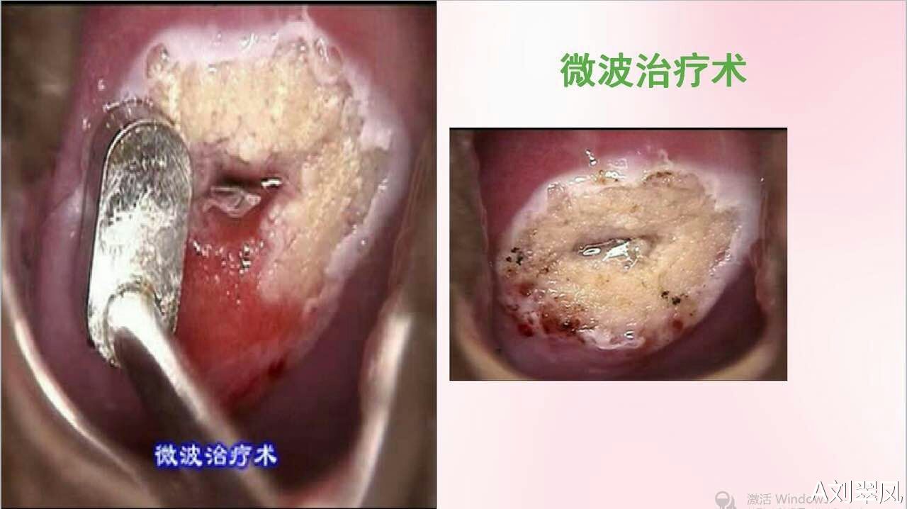 宫颈糜烂最新手术治疗，进展、优势与未来展望综述